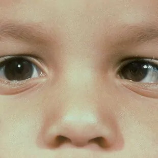 Squint & Paediatric Ophthalmology