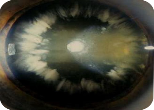 Cataract Eye Image - Cortical Cataract