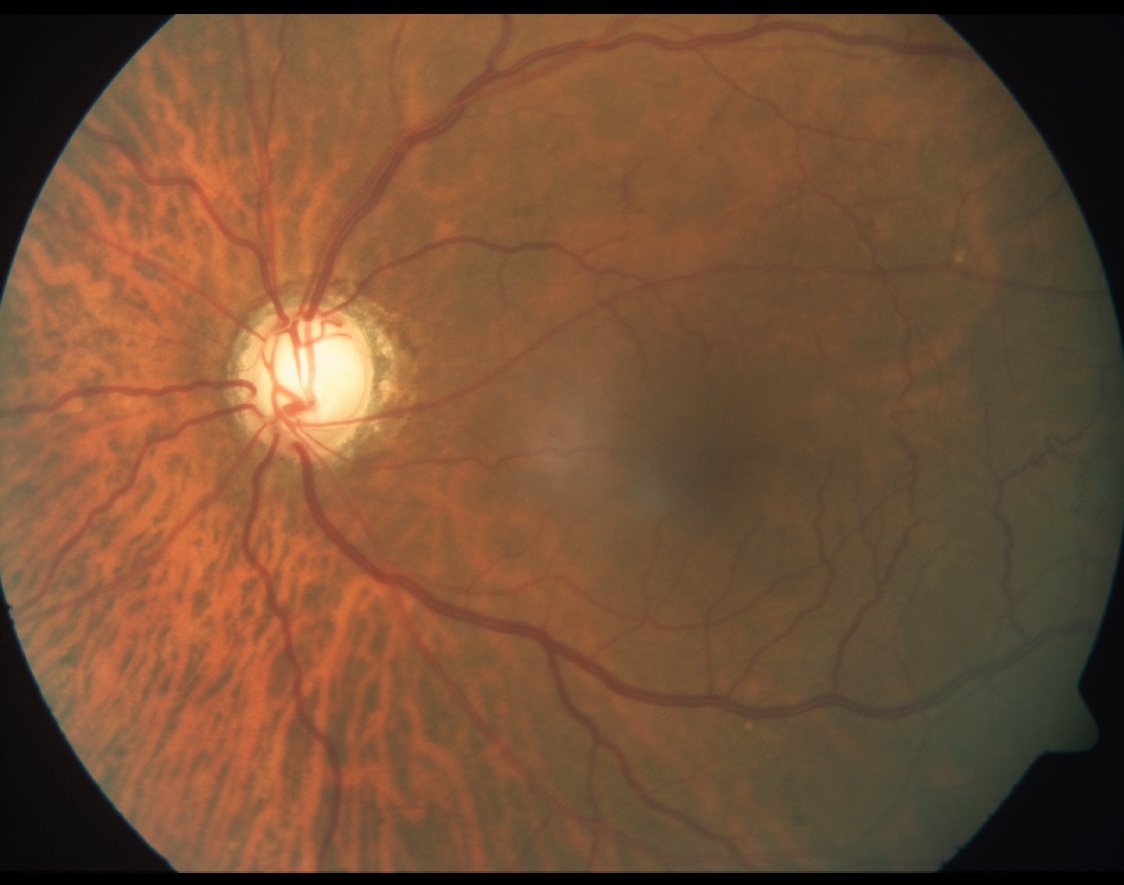 Moderate Glaucoma Image
