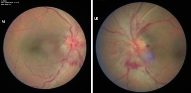 Optic nerve Swelling Treatment in Eye Foundation