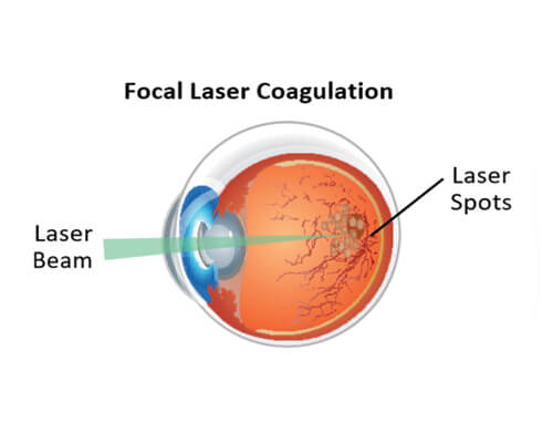 focal-laser-coagulation