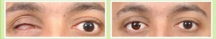 Ocular Prosthesis Treatment