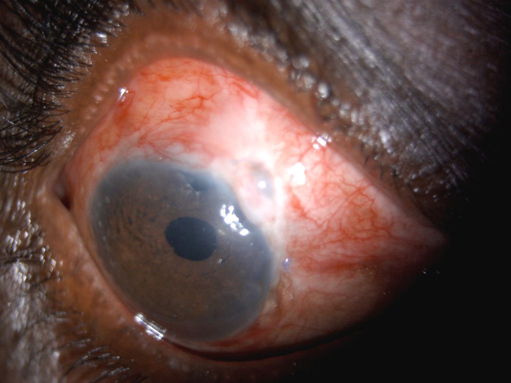 Glaucoma Surgery in Eye Foundation - Trabeculotomy
