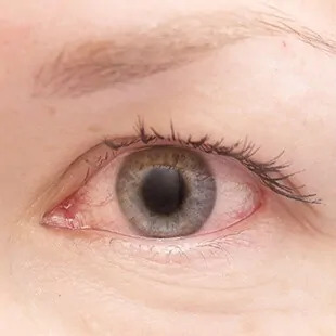 Uvea & Ocular Inflammation